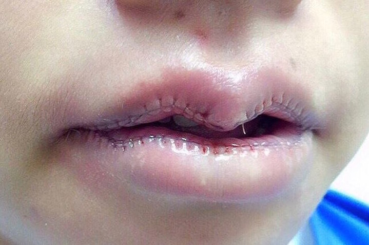 4. «Ушивание губ»